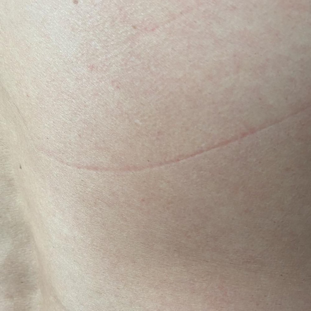 This one was painful after putting some ointment on it to keep the sensation down This one was painful after putting some ointment on it to keep the sensation down