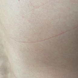 This one was painful after putting some ointment on it to keep the sensation down