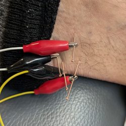 Carole Reuter, DC - Pain and swelling, gone!!! Love the acupuncture with the electrodes.