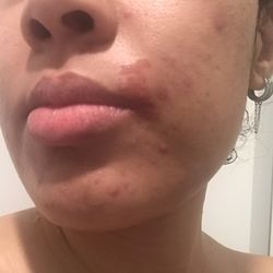 Perfect Brows NYC - This was the bruise from waxing my upper lip- never had this happen before!!