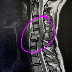 Gundersen Health System - Initial MRI showing infection and damage it caused