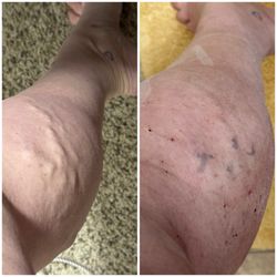 Albert Vein Institute - Before and after. I have a few more procedures to do. This picture was just the first procedure and I'm thrilled with my results.
