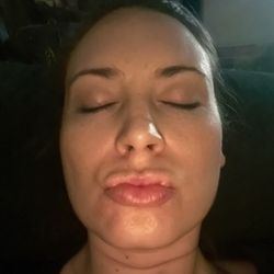 Kalos Facial Plastic Surgery - Before (ugly upper lip- botched by another Dr- no solution til I found Dr. Stong)