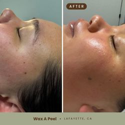 Wax A Peel - Before and after of our IMPACT Brightening PDRN Peel