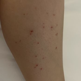 Downtown Sugar - Skin on leg clipped by tweezing - Skin Care Near Me - Santa Ana, California