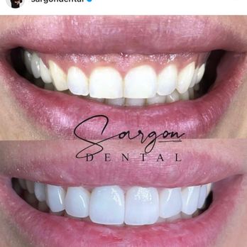 Sargon Dental - Dental Veneers by Dr. Sargon Lazarof, a top cosmetic dentist in West Hollywood, CA. Call (310) 800-1060 to schedule your dental consultation - General Dentistry Near Me - West Hollywood, California Sargon Dental - Dental Veneers by Dr. Sargon Lazarof, a top cosmetic dentist in West Hollywood, CA. Call (310) 800-1060 to schedule your dental consultation - General Dentistry Near Me - West Hollywood, California