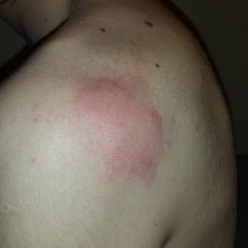 K & E Motor Inn - Bed bug bite - Hotels Near Me - Edmonds, Washington