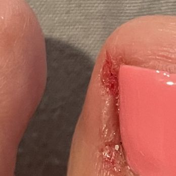 Vincent Nails and Spa - This is 6 hours after my pedicure. Look at how he literally shaved off a piece of my skin with the drill - Nail Salons Near Me - Palmdale, California Vincent Nails and Spa - This is 6 hours after my pedicure. Look at how he literally shaved off a piece of my skin with the drill - Nail Salons Near Me - Palmdale, California