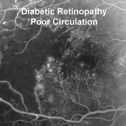 Retina Vitreous Associates of Florida - Fluorescein Angiography
