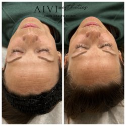 AIVI Aesthetics - Deluxe HydraFacial