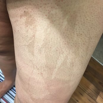 Waxing The City - After waxing ! Scars burnt - Waxing Near Me - Columbia, South Carolina