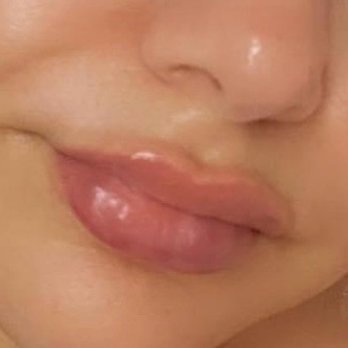 Not Just Lips - Refill from another place. So soft no visible bumps. - MM Aesthetics in Brooklyn - Aestheticians Near Me - New York, New York Not Just Lips - Refill from another place. So soft no visible bumps. - MM Aesthetics in Brooklyn - Aestheticians Near Me - New York, New York