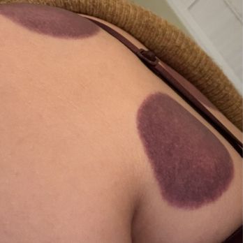 Hao Leng Acupuncture - After cupping from Dr. Leng - Acupuncture Near Me - Irvine, California Hao Leng Acupuncture - After cupping from Dr. Leng - Acupuncture Near Me - Irvine, California