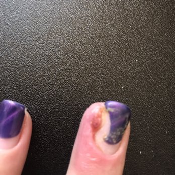 Enchanted Beauty Spa - Post-antibiotics. The swelling has increased and I need to see a dermatologist. - Nail Salons Near Me - Mendota Heights, Minnesota