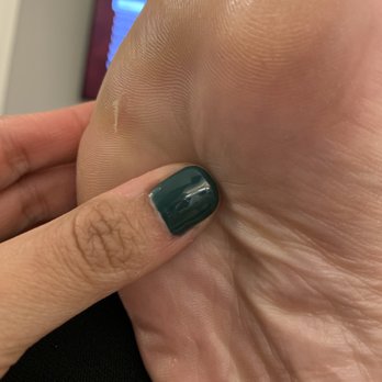 Aura Day Spa - Callous removal where they cut your skin and let it be raw. - Day Spas Near Me - Arlington, Virginia Aura Day Spa - Callous removal where they cut your skin and let it be raw. - Day Spas Near Me - Arlington, Virginia