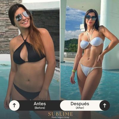 Before & After - Sublime opens its doors in Colombia and the United States with the aim of providing an unbeatable experience in the search for that light that makes you shine. Today, more than ever, we are convinced that all human beings have that light that makes them extraordinary. Our purpose will always be to increase your confidence and for you to believe in the great power that you have, which is why we have a high-quality and excellent medical team, in addition to a human talent trained to provide you with a SUBLIME experience. Before & After - Sublime opens its doors in Colombia and the United States with the aim of providing an unbeatable experience in the search for that light that makes you shine. Today, more than ever, we are convinced that all human beings have that light that makes them extraordinary. Our purpose will always be to increase your confidence and for you to believe in the great power that you have, which is why we have a high-quality and excellent medical team, in addition to a human talent trained to provide you with a SUBLIME experience.