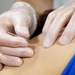 Dynamic Physical Therapy - Dry Needling
