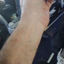 Bed bug bites