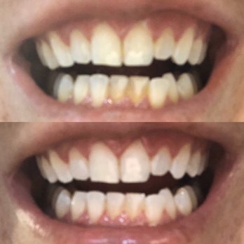 Magic Smile - Before and After - Teeth Whitening Near Me - New York, New York