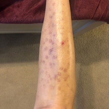 Moran Laser And Salon - My legs are ruined - Tattoo Removal Near Me - Nashville, Tennessee Moran Laser And Salon - My legs are ruined - Tattoo Removal Near Me - Nashville, Tennessee