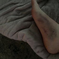 Vermont River Tubing - Injury from slipping on rocks