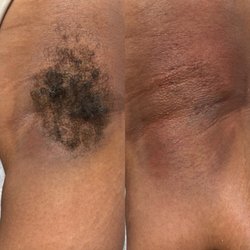 Birmingham Wax Bar - Before/After Underarm Wax