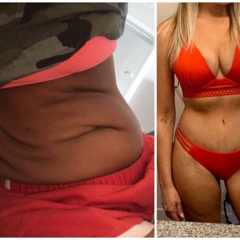 Michael Diaz, M.D. - Loose skin gone forever! - Plastic Surgeons Near Me - Melbourne, Florida Michael Diaz, M.D. - Loose skin gone forever! - Plastic Surgeons Near Me - Melbourne, Florida
