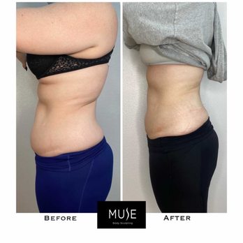 Muse Body Sculpting - Body Contouring Near Me - Signal Hill, California Muse Body Sculpting - Body Contouring Near Me - Signal Hill, California