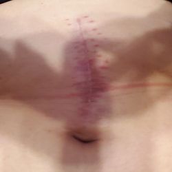Surgical Associates Of Warner Robins - I know there's a shadow but you can see the scar that Dr. McBride was so proud of.