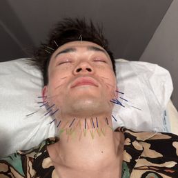 Beauty acupuncture Beauty acupuncture