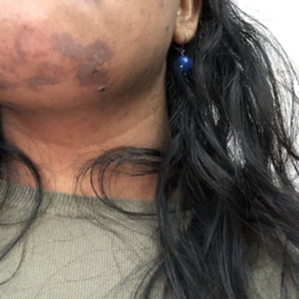 SpaFit Nation - Skin burn post laser - which was the 3rd time. Peeled off my skin. Beware. Rude people. - Day Spas Near Me - Jericho, New York SpaFit Nation - Skin burn post laser - which was the 3rd time. Peeled off my skin. Beware. Rude people. - Day Spas Near Me - Jericho, New York
