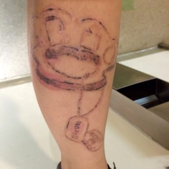 Marta Recasens MediSpa - After the first treatment , little blistering - Tattoo Removal Near Me - Glendale, California Marta Recasens MediSpa - After the first treatment , little blistering - Tattoo Removal Near Me - Glendale, California