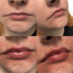 Lips