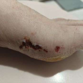 Create Beauty Nail - Burn received from pedicure. - Nail Salons Near Me - Brooklyn, New York Create Beauty Nail - Burn received from pedicure. - Nail Salons Near Me - Brooklyn, New York