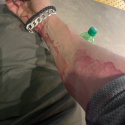 University of Virginia Medical Center Hospitals - Had to pull my own IV out after waiting 5 hours