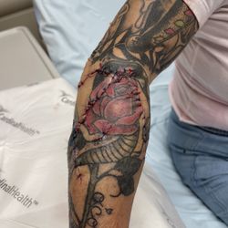 Hilo Benioff Medical Center - Complete repair with 36 stitches