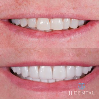 JJ Dental - General Dentistry Near Me - Pompano Beach, Florida JJ Dental - General Dentistry Near Me - Pompano Beach, Florida