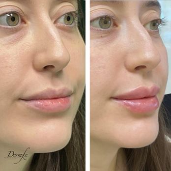 DermFx - Lip filler - Medical Spas Near Me - Dana Point, California DermFx - Lip filler - Medical Spas Near Me - Dana Point, California