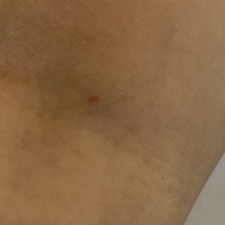 Sun Clinical Laboratories - Blood drawn left only a tiny red dot:) And surprisingly, no bruising~Because I usually bruise Very Easily!! XO