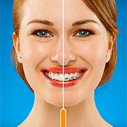 Liberty Orthodontic Centre - Dr. Arun Rajasekaran - Invisalign is the ultimate esthetic option for adults who do not want to wear braces.