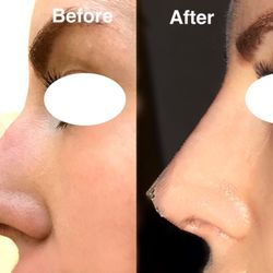 Eon Medical Spa - Non-Surgical Nose Job By Joyti.