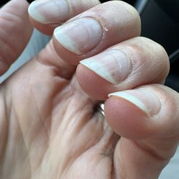 Nail damage Nail damage