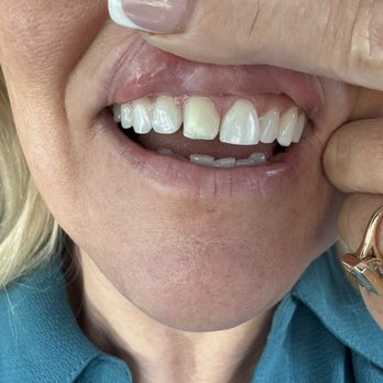 Don Solooki, DDS - Calm Dental - This is the previous veneer that fell off, was poorly shaped, and didn't match my natural smile at all. - Cosmetic Dentists Near Me - Los Angeles, California Don Solooki, DDS - Calm Dental - This is the previous veneer that fell off, was poorly shaped, and didn't match my natural smile at all. - Cosmetic Dentists Near Me - Los Angeles, California