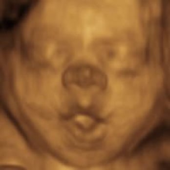 4D Prenatal Imaging - 3D ultrasound at 27 weeks. - Medical Centers Near Me - Miami, Florida 4D Prenatal Imaging - 3D ultrasound at 27 weeks. - Medical Centers Near Me - Miami, Florida