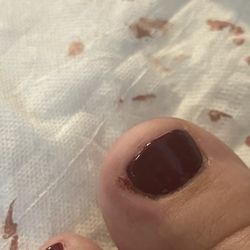 Expo Nails - Open wound infection