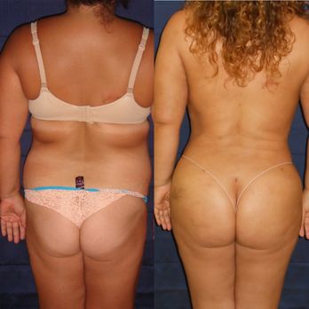 Clínica Renueva - Tummy tuck and BBL - Cosmetic Surgeons Near Me - Tijuana, BCN Clínica Renueva - Tummy tuck and BBL - Cosmetic Surgeons Near Me - Tijuana, BCN