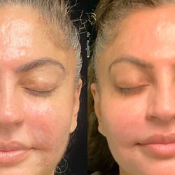 The Laser & Rejuvenation Center - Morpheus8 before/after