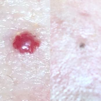 Orchid Beauty & Spa - Before & After of my Cherry Angioma removal! Couldn't be happier! - Skin Care Near Me - Campbell, California