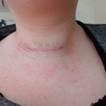 Clayman Thyroid Center - My scar status post partial thyroidectomy -post op day 1. - Oncologist Near Me - Town 'n' Country, Florida Clayman Thyroid Center - My scar status post partial thyroidectomy -post op day 1. - Oncologist Near Me - Town 'n' Country, Florida