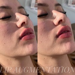 Skin Canvas Aesthetics - Lip Augmentation by Nurse Paty